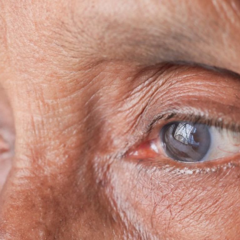 que-catarata-sintomas-causas-tipos-tratamento_widexl